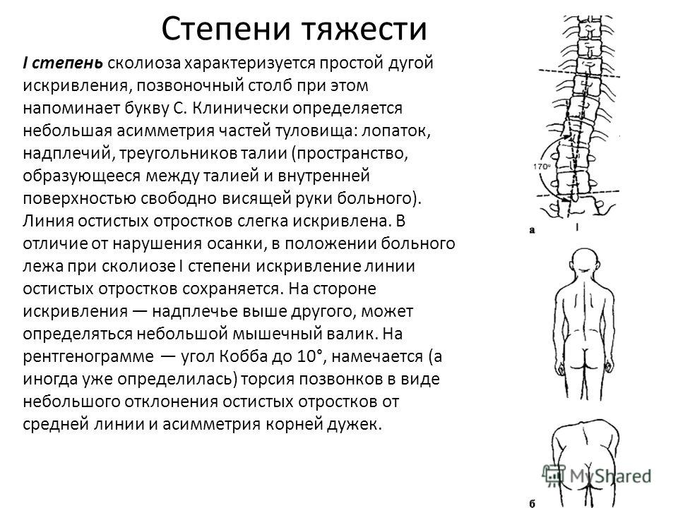 S-образного позвоночника S-образного позвоночника