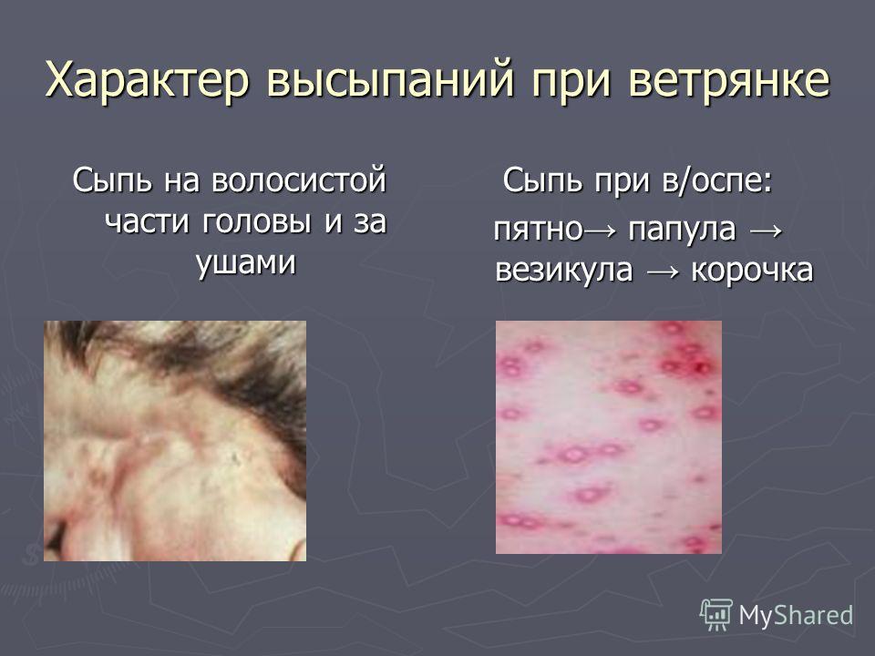 Полиморфизм сыпи пятно папула везикула характерна для Полиморфизм сыпи пятно папула везикула характерна для