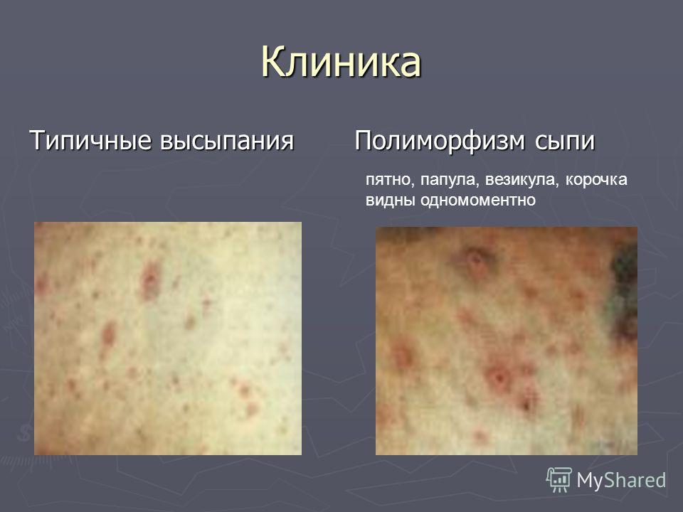 На тату не образовывается корочка На тату не образовывается корочка