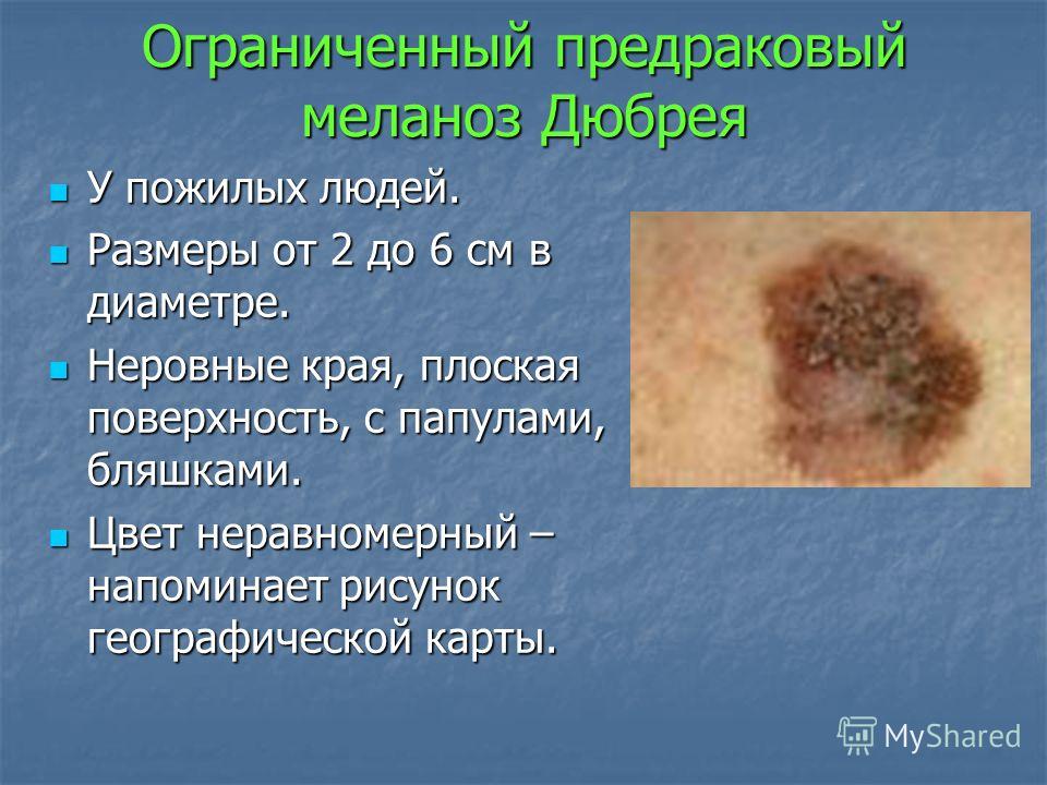 фото меланоз дюбрея онлайн фото меланоз дюбрея