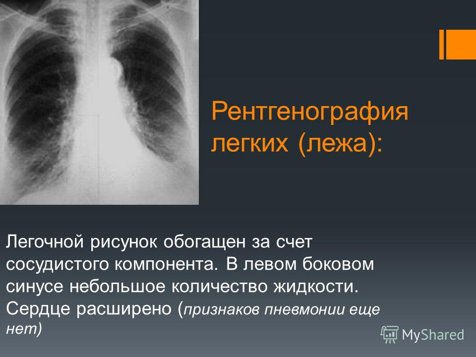 Усилен прикорневой рисунок легких Усилен прикорневой рисунок легких