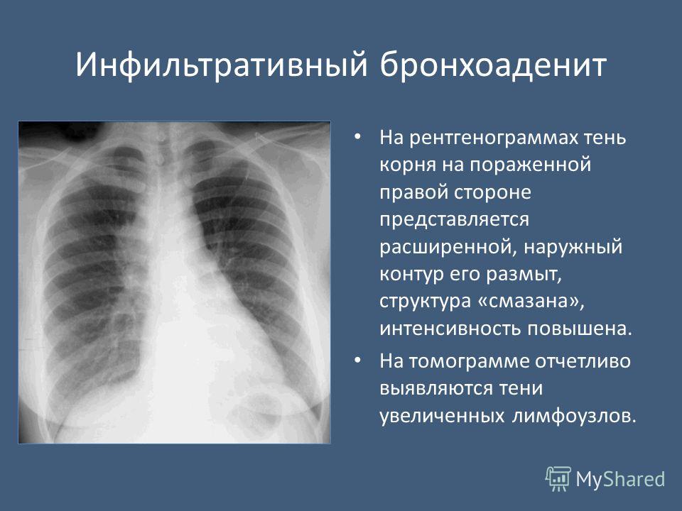 Корни уплотнены.легочный рисунок диффузно усилен Корни уплотнены.легочный рисунок диффузно усилен
