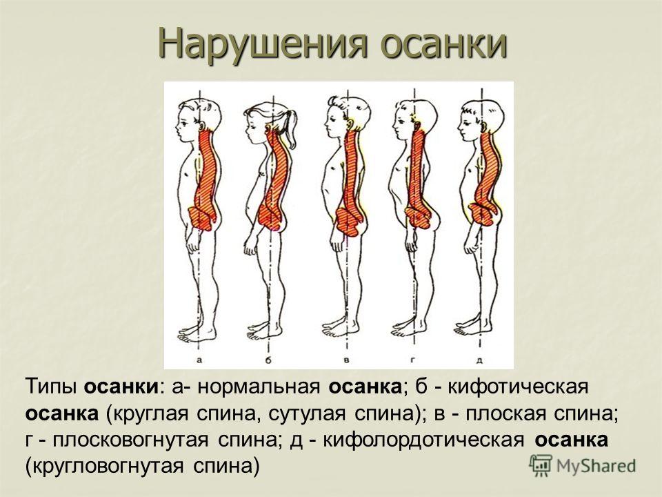 Как сделать спину ровной и не сутулится Как сделать спину ровной и не сутулится