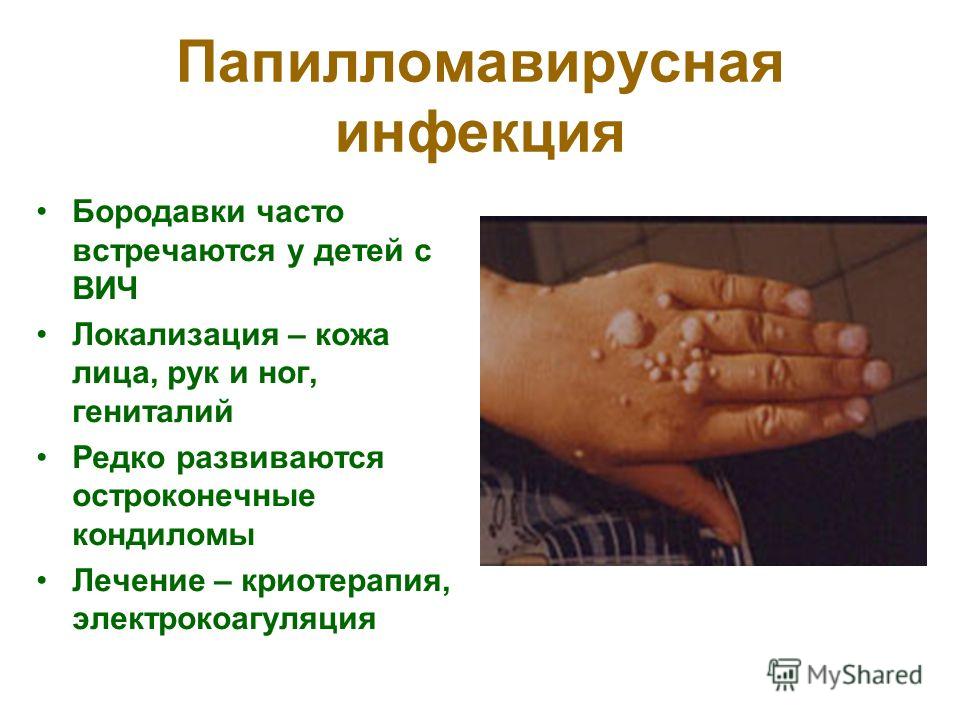 infektsiyu foto lechit papilomavirusnuyu kak izvinyayus no Папиломавирусную инфекцию как лечить фото фото