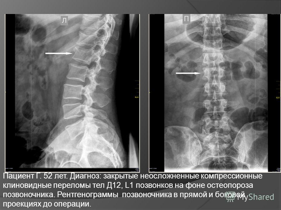 Неосложненный перелом тел позвоночника Неосложненный перелом тел позвоночника