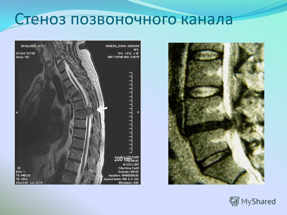 Стеноз позвоночного канала позвоночника Стеноз позвоночного канала позвоночника