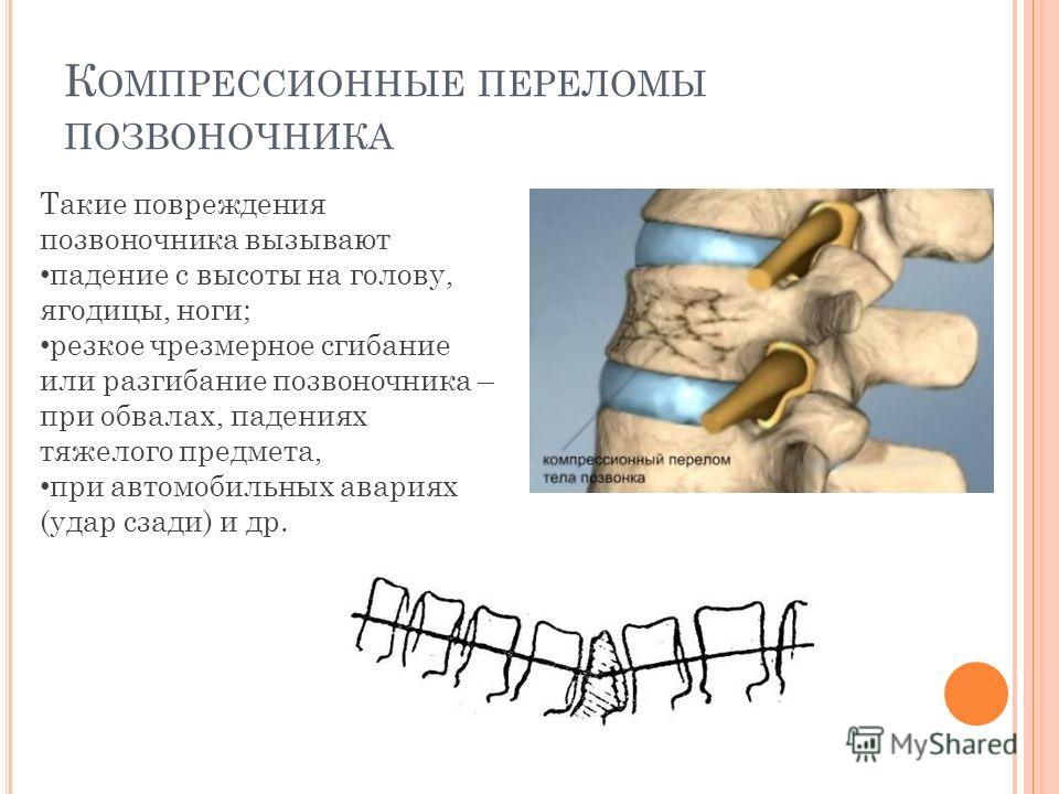 Периоды компрессионный перелома позвоночник Периоды компрессионный перелома позвоночник