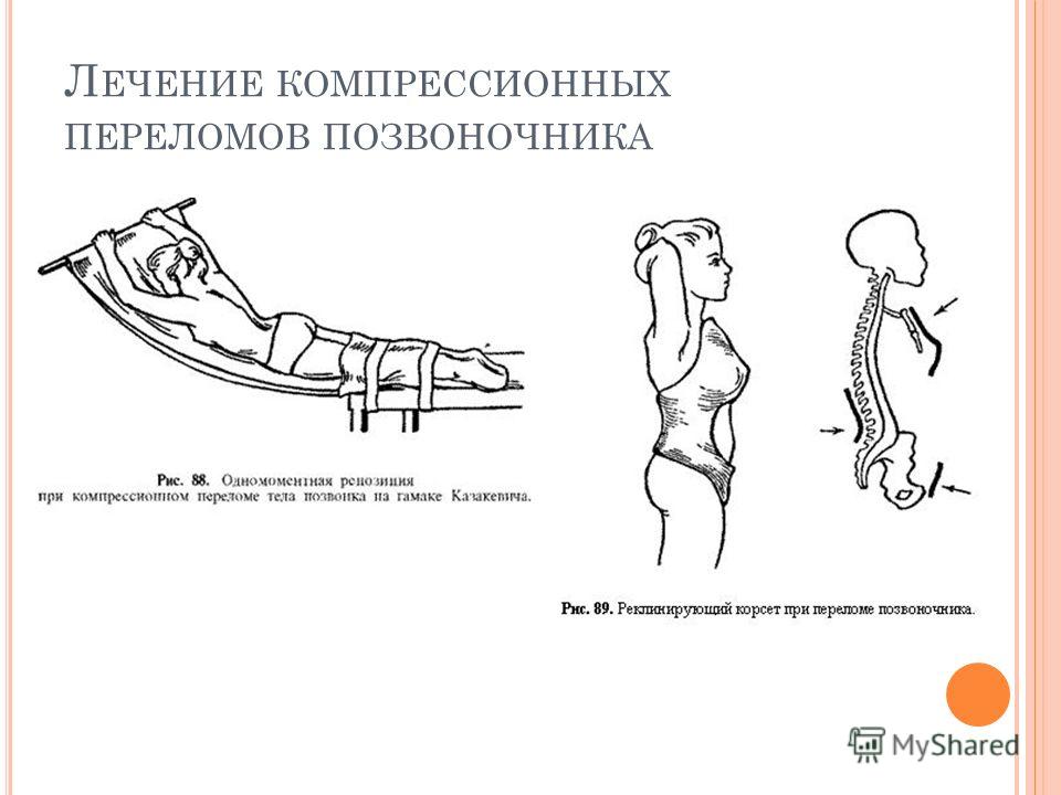 Периоды компрессионный перелома позвоночник Периоды компрессионный перелома позвоночник