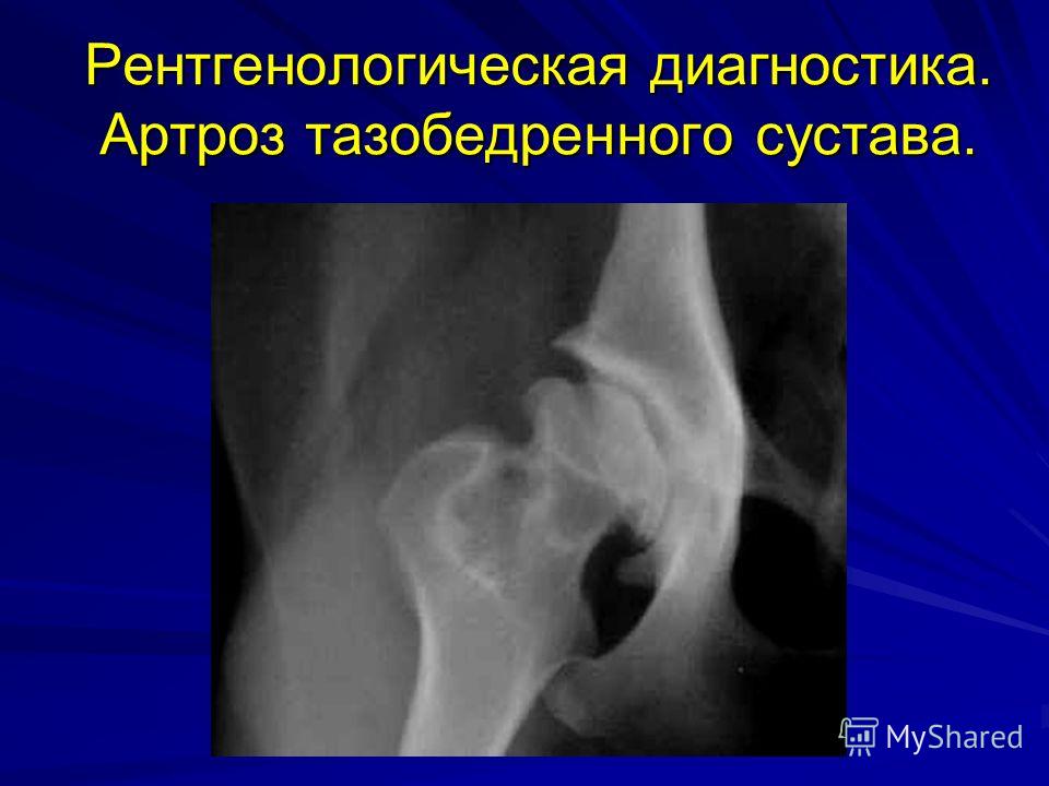 Тазобедренный сустав диагностика заболеваний Тазобедренный сустав диагностика заболеваний