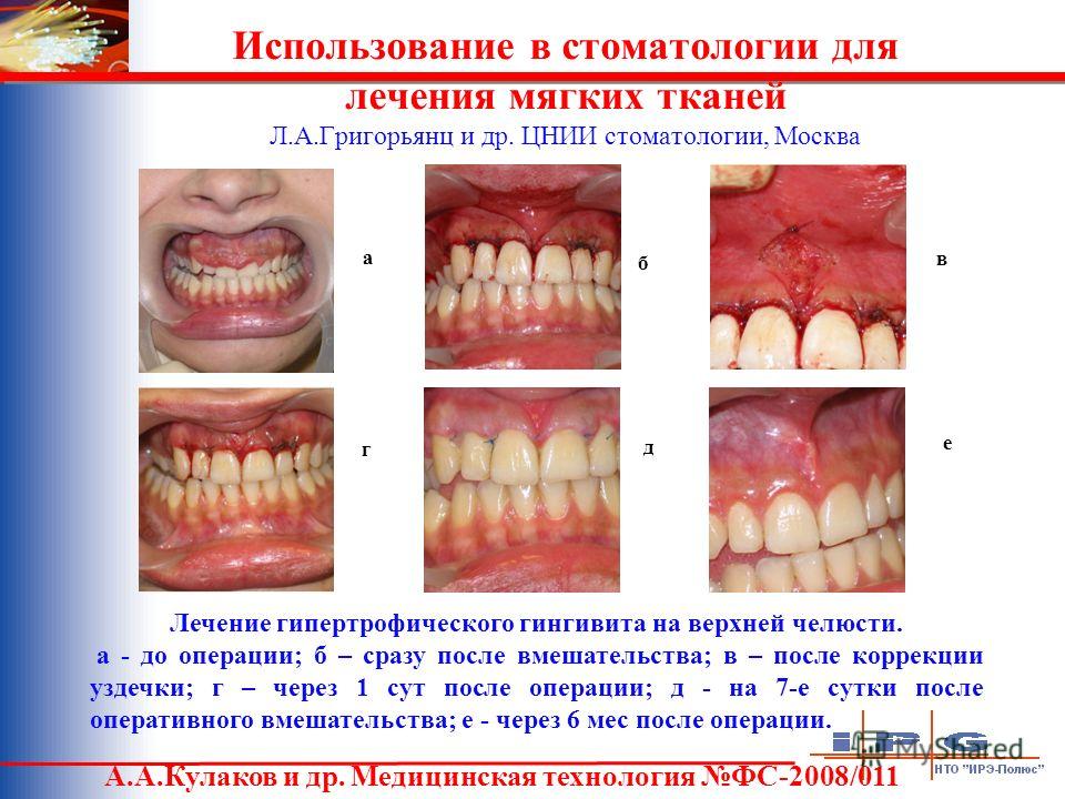 Что такое коррекция уздечки языка Что такое коррекция уздечки языка