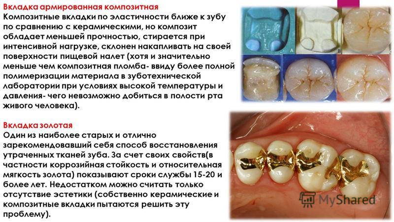 Композитные вкладки на зубы все свои Композитные вкладки на зубы все свои