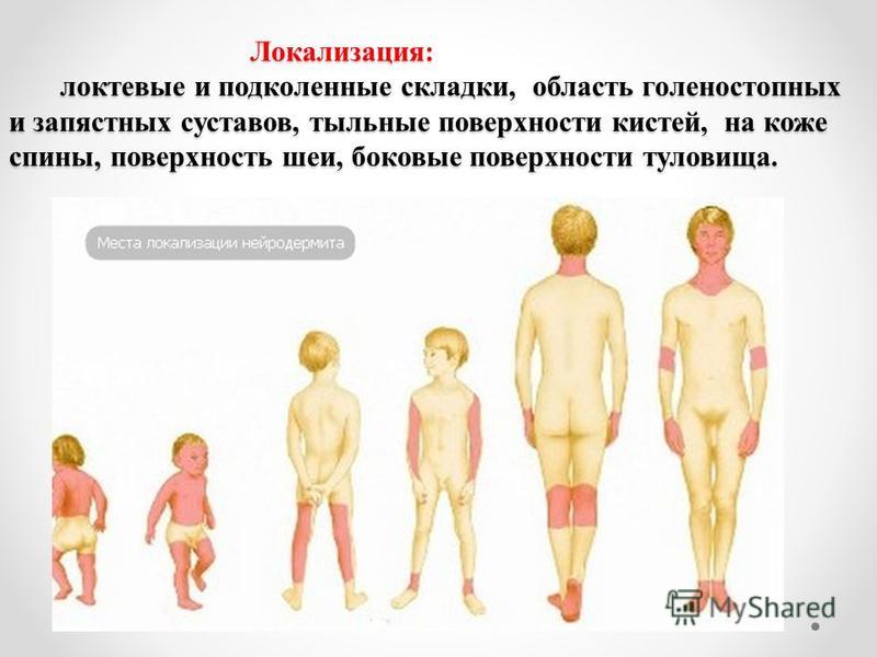 Дисгидротическая экзема на руках
