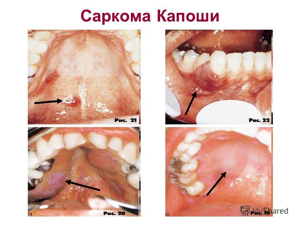 Коревая сыпь после прививки - Про прививки Коревая сыпь после прививки - Про прививки