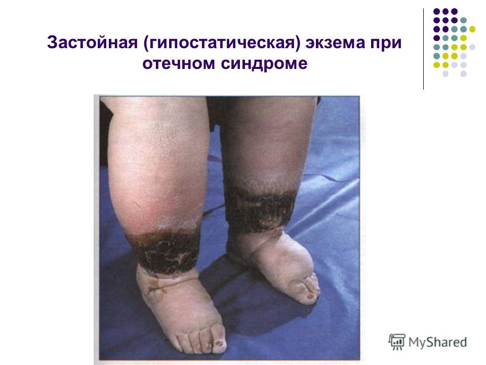 Презентация На Тему Экзема Презентация На Тему Экзема