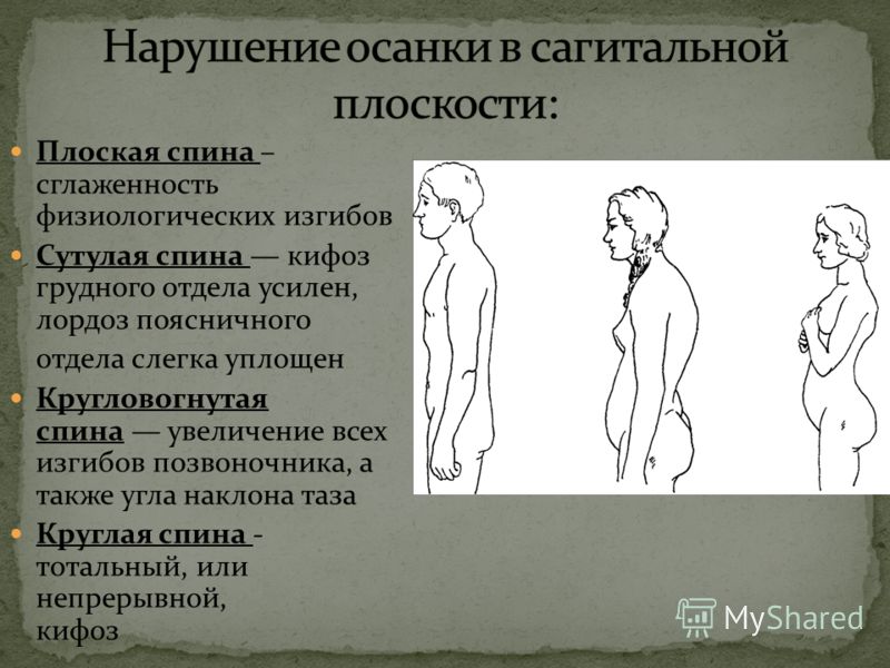Усилен кифоз позвоночника Усилен кифоз позвоночника