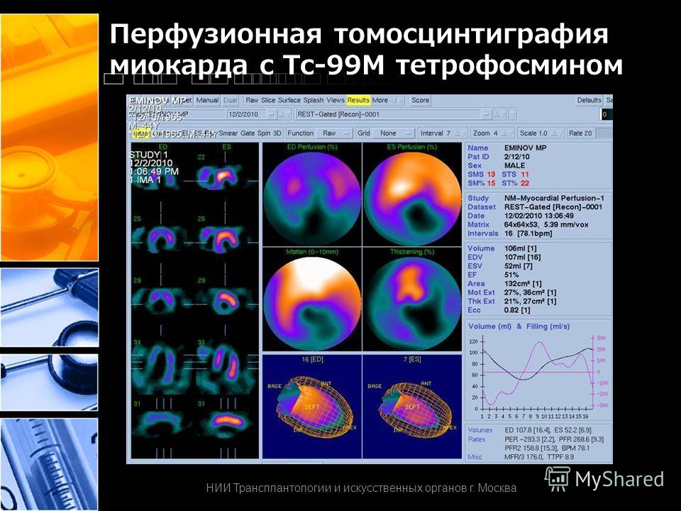 Перфузионная томосцинтиграфия миокарда с Тс-99М тетрофосмином НИИ Трансплантологии и искусственных органов г. Москва