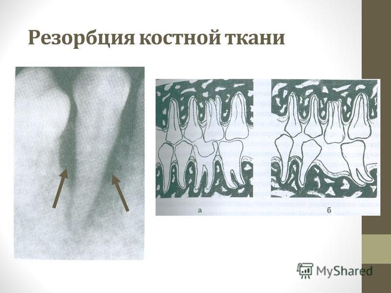 Если от зубов уходит костная ткань Если от зубов уходит костная ткань