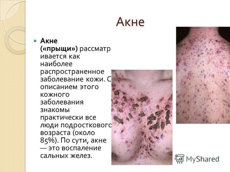 У ребенка вши? Лечение педикулеза за один раз. Как. - 7я.ру Сильная молитва для очищения дома и квартиры - m