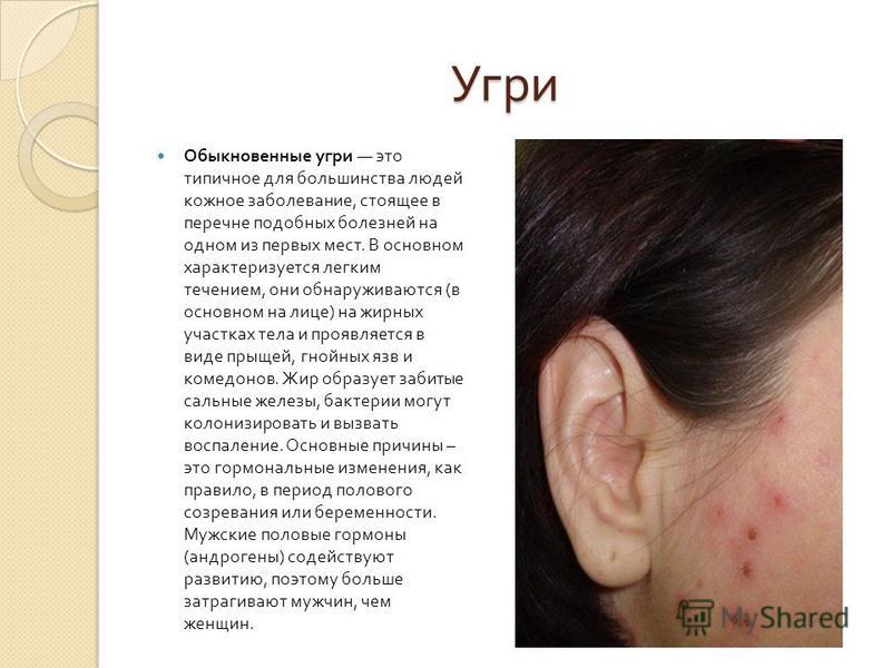 Болезни кожи угревая болезнь Болезни кожи угревая болезнь