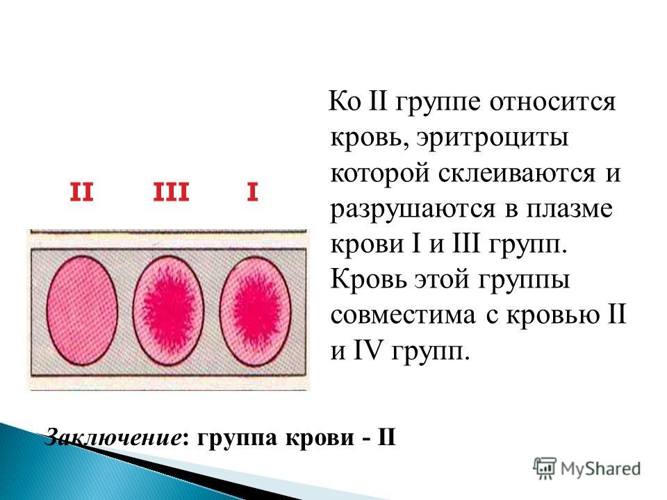 Ко II группе относится кровь, эритроциты которой склеиваются и разрушаются в плазме крови I и III групп. Кровь этой группы совместима с кровью II и IV