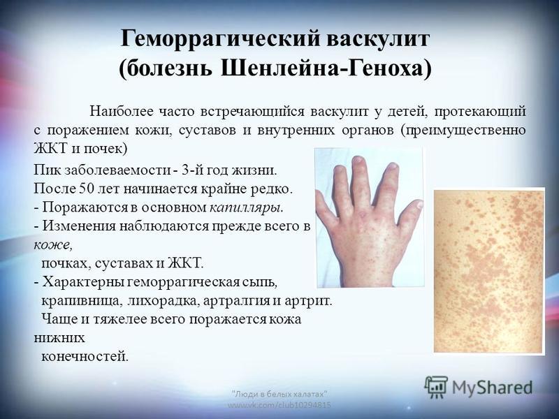 Сыпь при васкулите на ногах Сыпь при васкулите на ногах