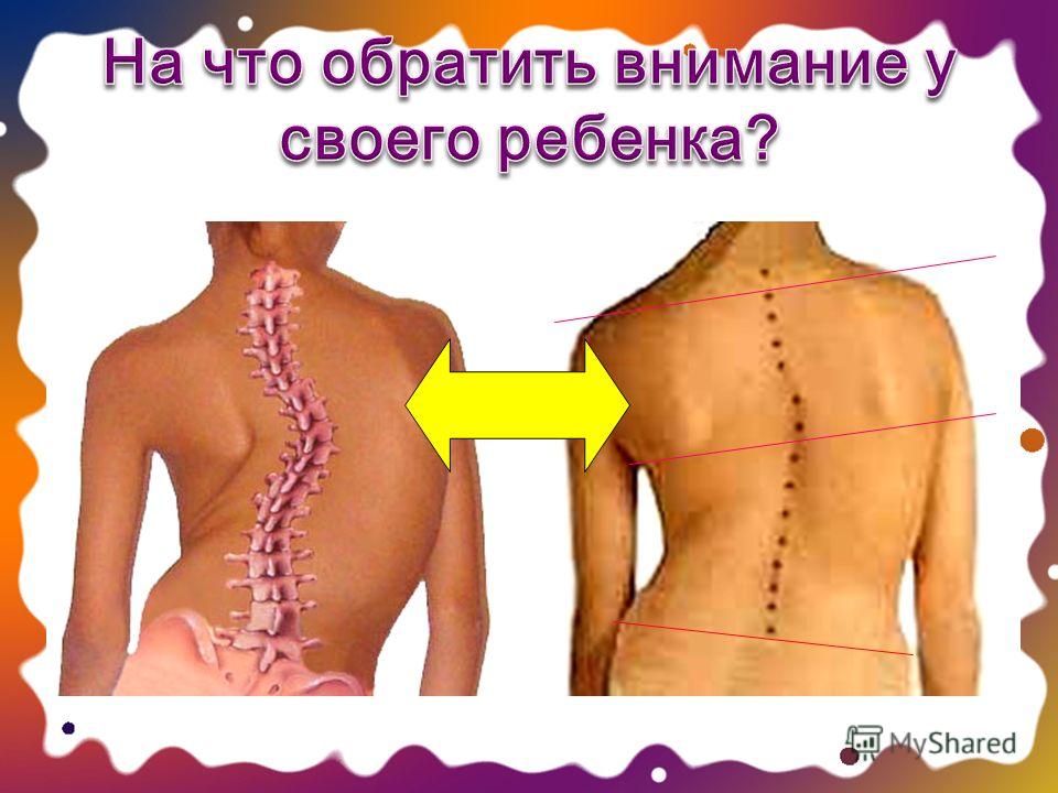 Сколиоз позвоночника клиника Сколиоз позвоночника клиника