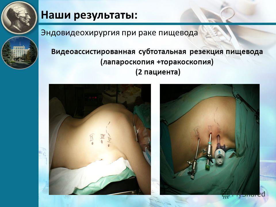 лапароскопия при раке матки лапароскопия при раке матки