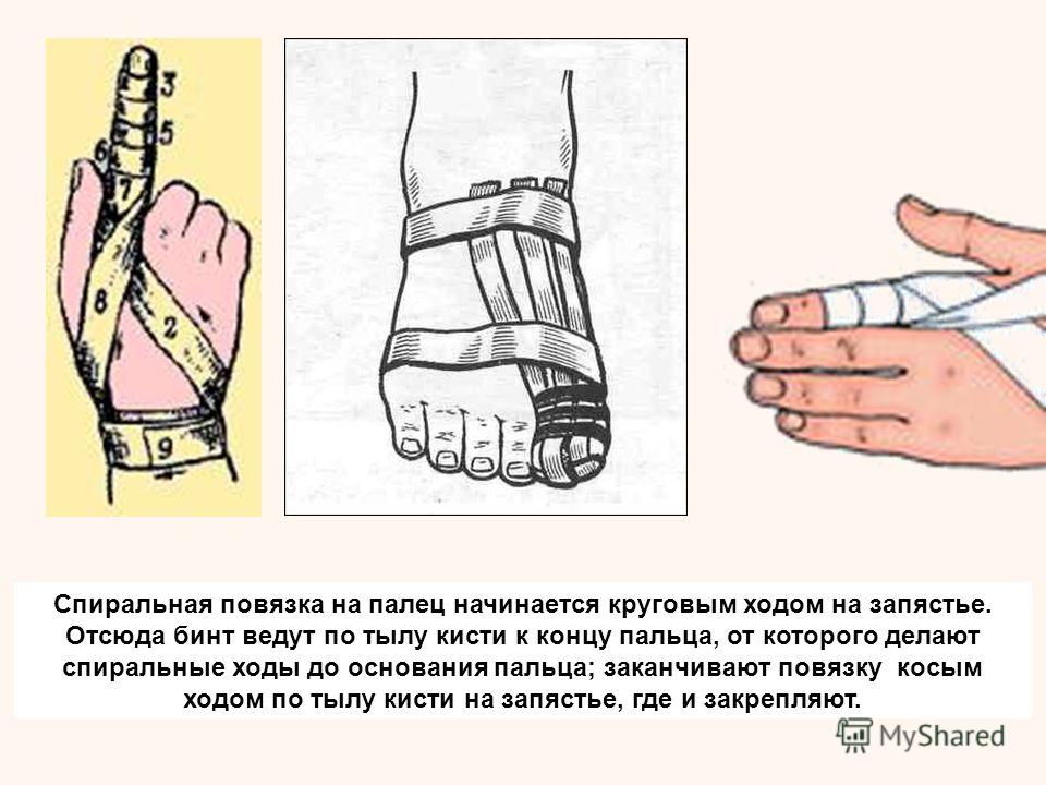 Спирто-бальзамическая повязка как сделать Спирто-бальзамическая повязка как сделать