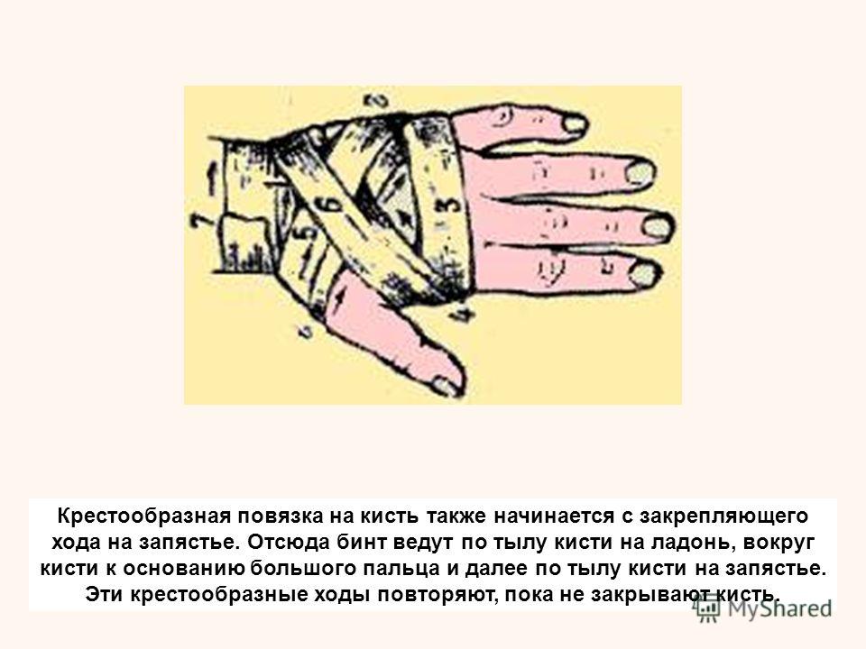 Схемы повязкой на кисть Схемы повязкой на кисть