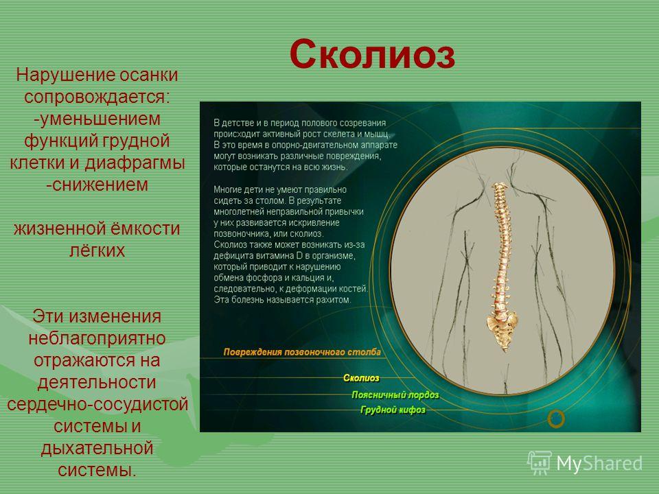 Проект 9 класс сколиоз Проект сколиоз 9 класс