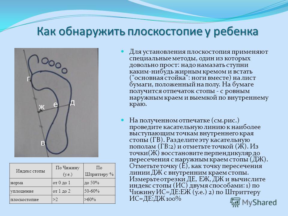 Определение плоскостопие в домашних условиях Определение плоскостопие в домашних условиях