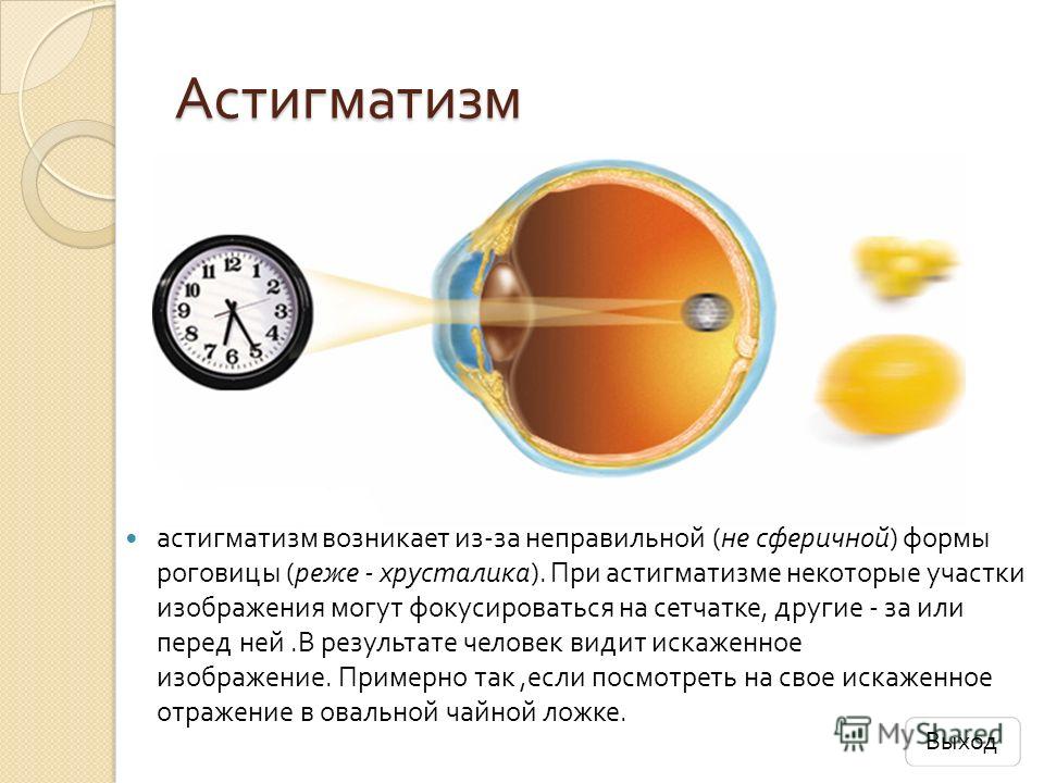 Все об лечении амблиопии