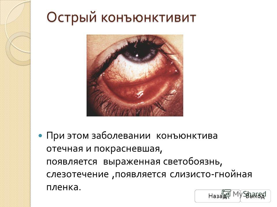 Большая разница зрения в глазах