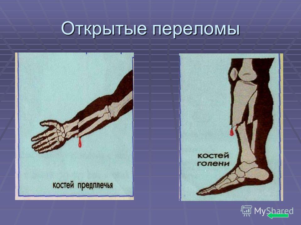 Перелом открытый локтевого сустава. Локтевой сустав – болезни, распространенные проблемы и их лечение Травматические повреждения и заболевания локтевого сустава Перелом локтя: лечение и последствия перелома локтевого сустава.