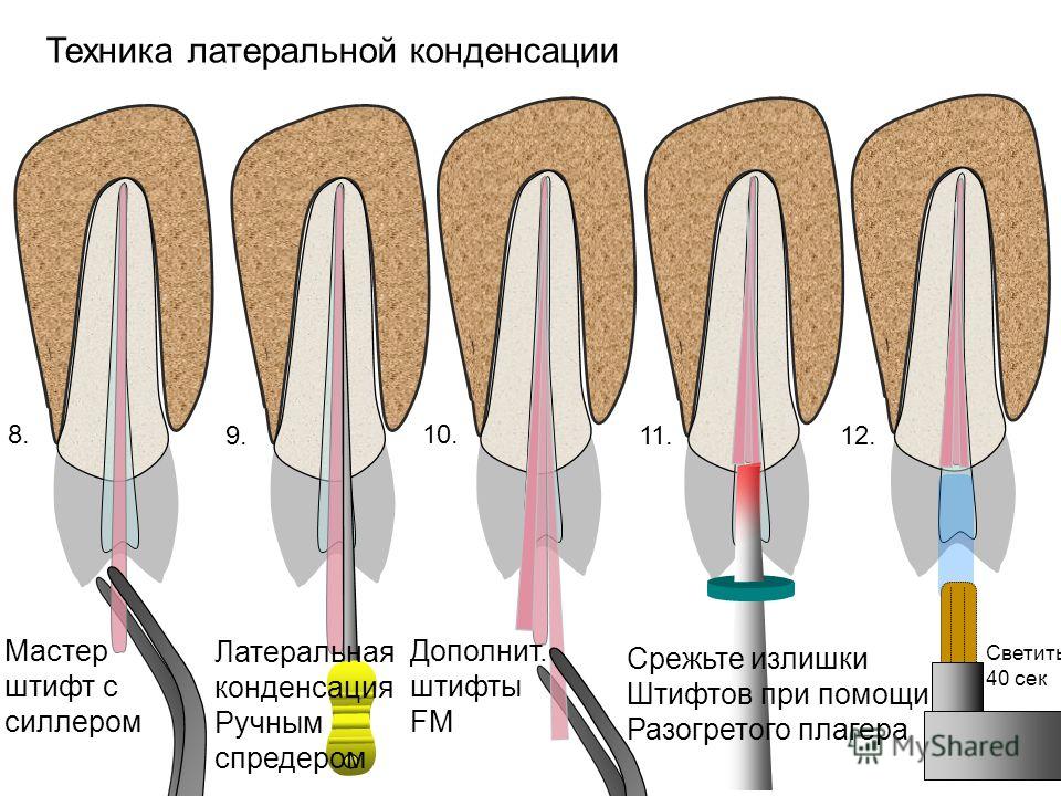 Для чего штифт при пломбировании зуба Для чего штифт при пломбировании зуба