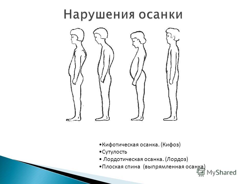 Программы лечения сколиоза