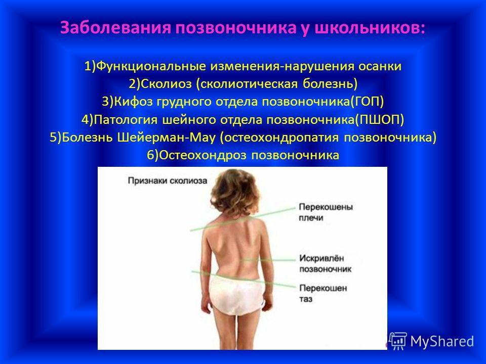 С чем связано искривление позвоночника С чем связано искривление позвоночника