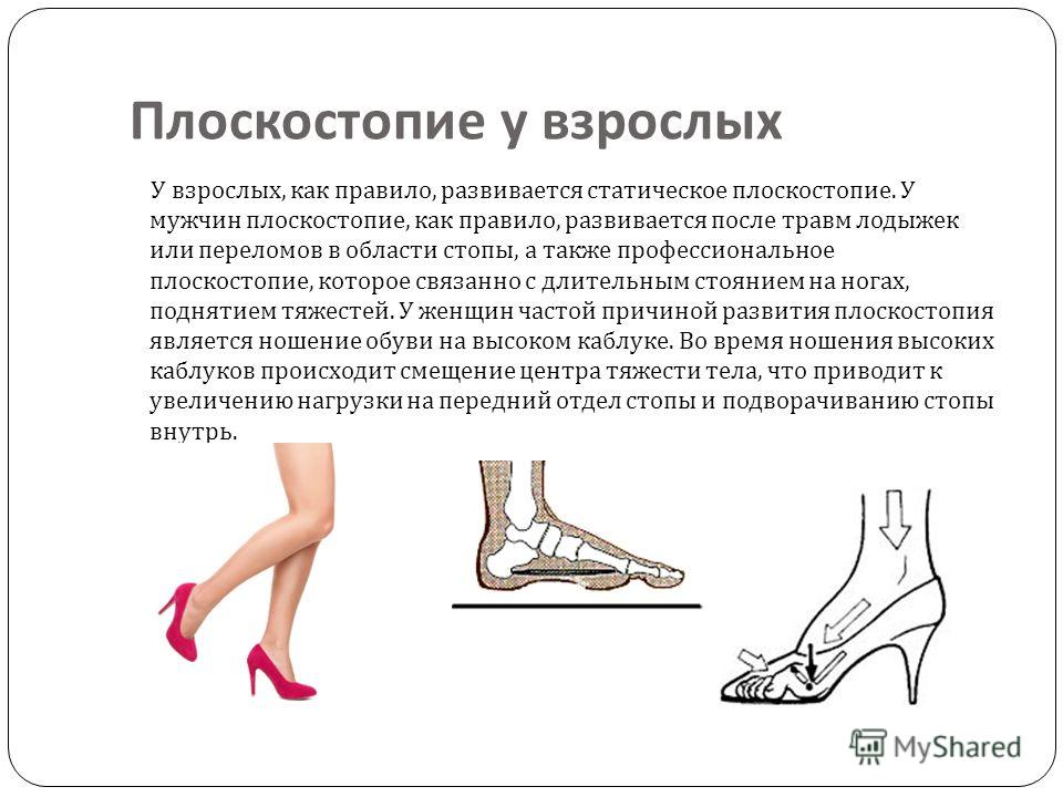 Как лечить плоскостопию в домашних условиях у взрослых Как лечить плоскостопию в домашних условиях у взрослых
