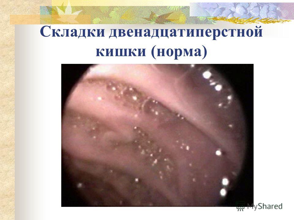 Как лечить двенадцатиперстной кишки на дому Как лечить двенадцатиперстной кишки на дому
