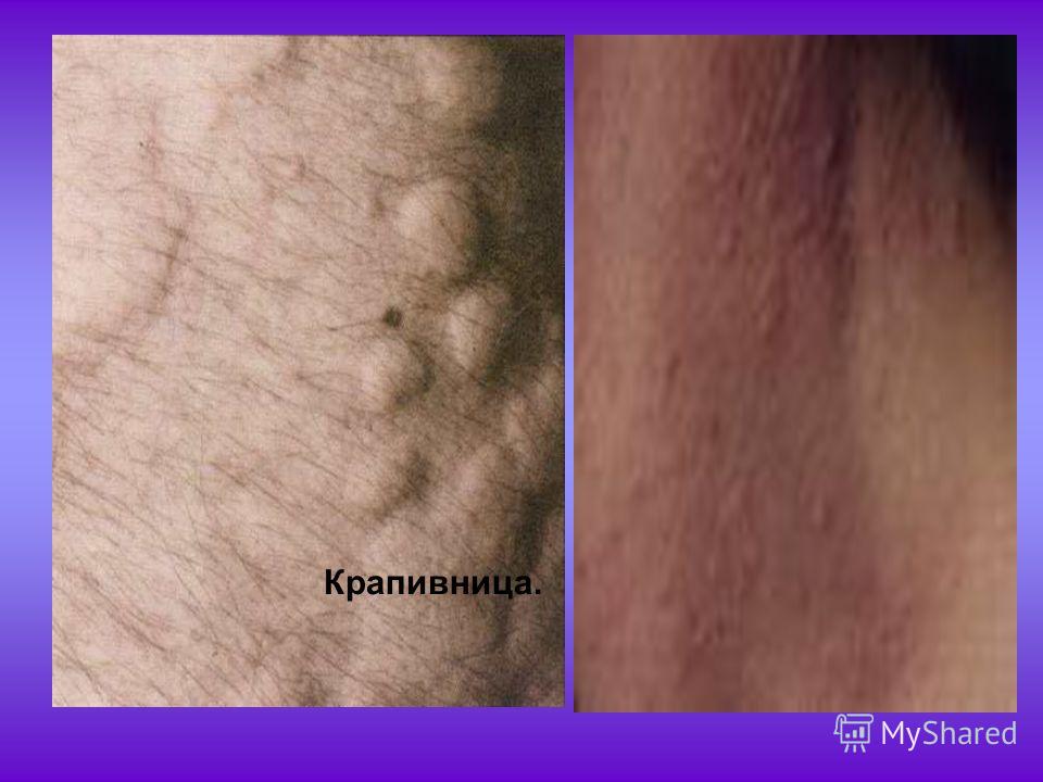 Как вылечить аллергию крапивницу в домашних условиях