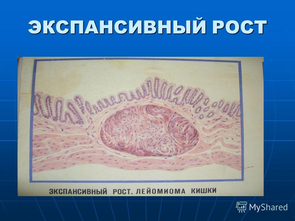 Реферат: Патология тканевого роста Опухоли