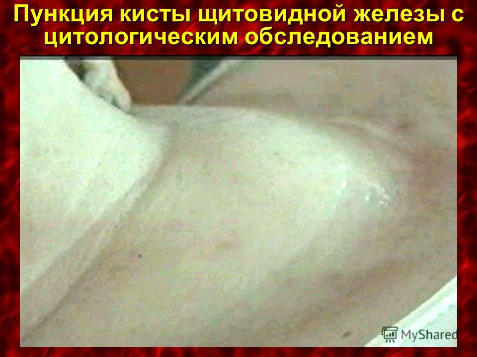 Обследование щитовидной железы своими руками Обследование щитовидной железы своими руками