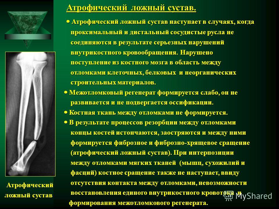 Формируется ложный сустав Формируется ложный сустав