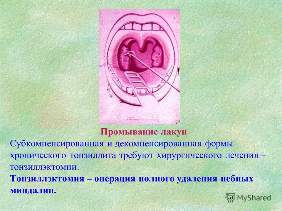 Как в домашних условиях промыть миндалины лакуны 140