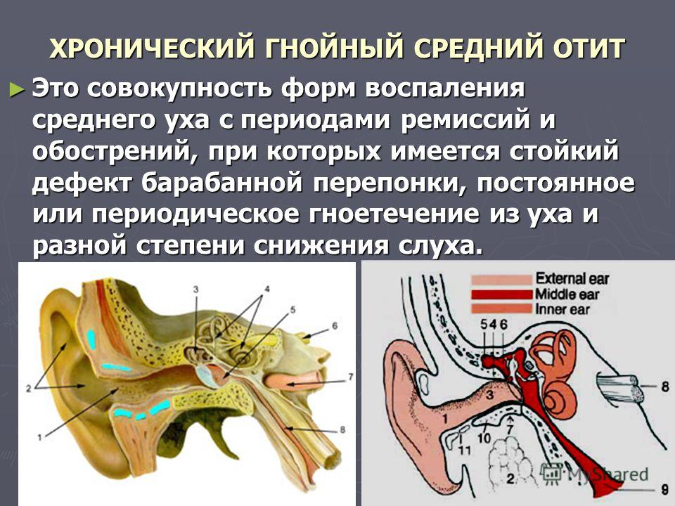 Как лечить хронический гнойный отит у взрослых Как лечить хронический гнойный отит у взрослых
