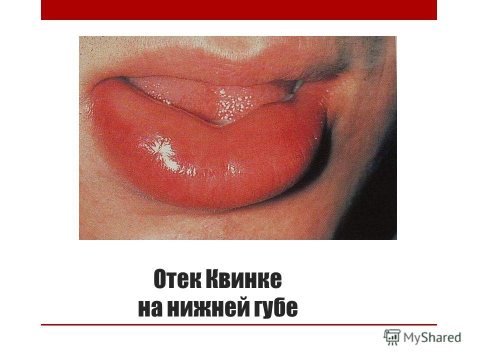Припухает нижняя губа Припухает нижняя губа