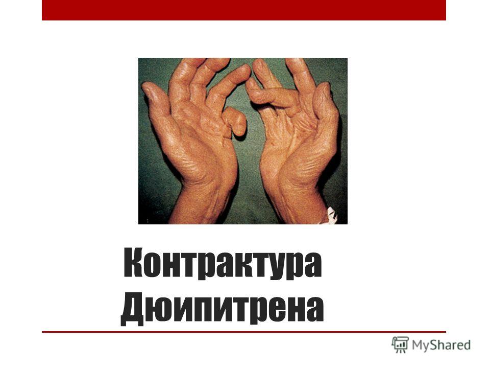 Сколько болит растянутая нога