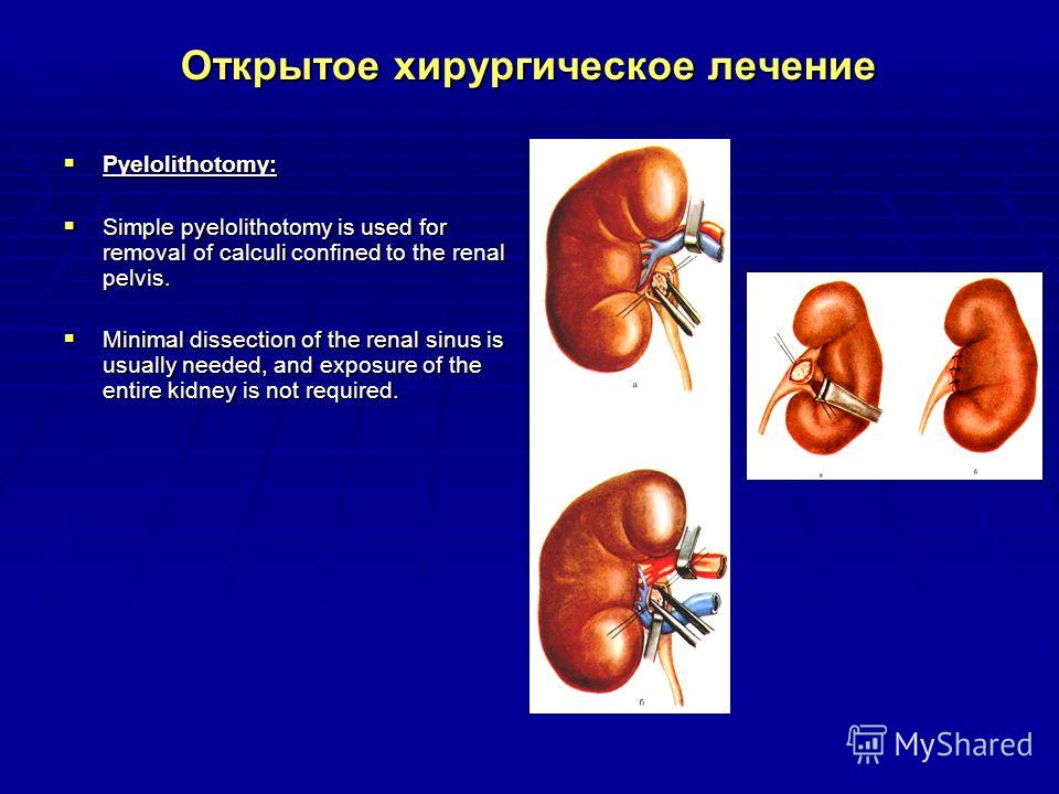 Симфизит как вылечить