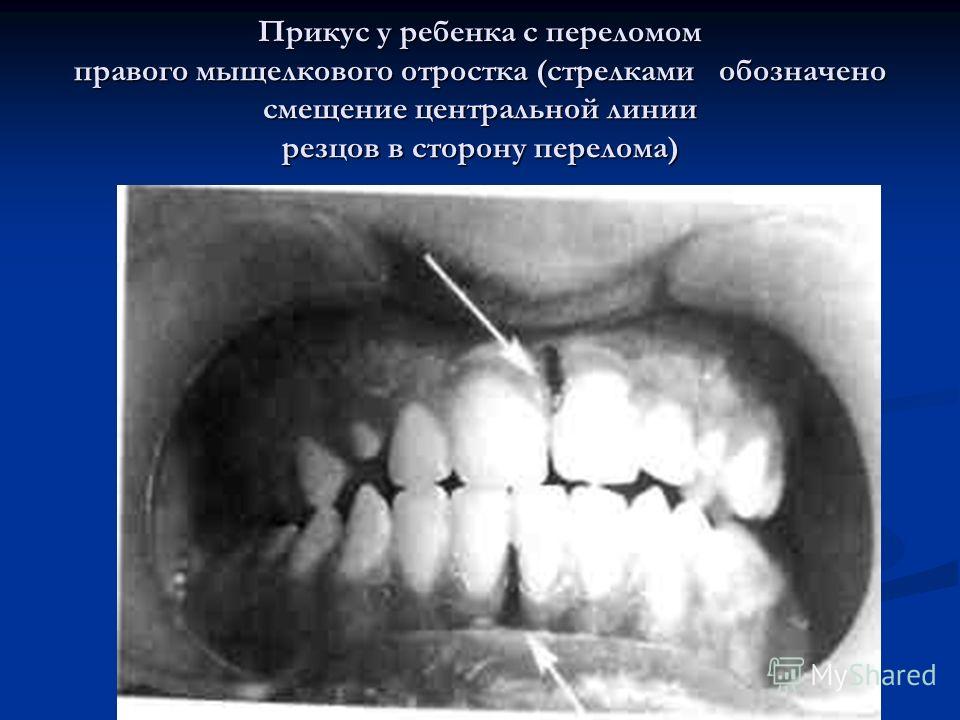 Зубы на линии переломов челюстей Зубы на линии переломов челюстей