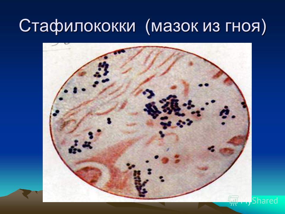 Как сделать мазок на стафилококк Как сделать мазок на стафилококк